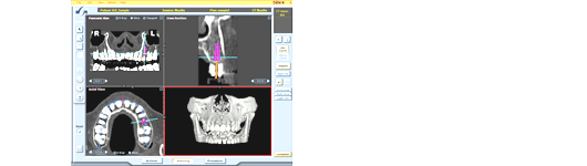 歯科インプラント手術用シミュレーションデータの作成